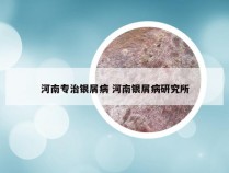 河南专治银屑病 河南银屑病研究所