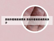 贵阳市看银屑病费用 贵阳市看银屑病费用多少