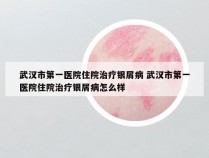 武汉市第一医院住院治疗银屑病 武汉市第一医院住院治疗银屑病怎么样