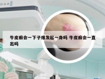 牛皮癣会一下子爆发起一身吗 牛皮癣会一直出吗
