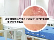 儿童银屑病三个多月了还没好 孩子的银屑病一直好不了怎么办