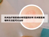 杭州治疗银屑病去哪家医院好啊 杭州银屑病哪种方法能可以治好