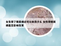 女生得了银屑病还可以身孩子么 女性得银屑病是否影响生育