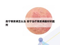 南宁银屑病怎么治 南宁治疗银屑病最好的医院