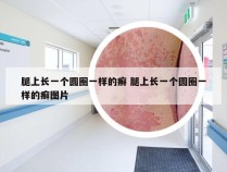 腿上长一个圆圈一样的癣 腿上长一个圆圈一样的癣图片