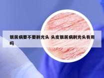 银屑病要不要剃光头 头皮银屑病剃光头有用吗