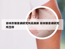 郑州市银屑病研究所高颜捧 郑州银屑病研究所怎样