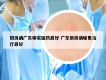 银屑病广东哪家医院最好 广东银屑病哪里治疗最好