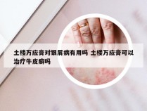 土楼万应膏对银屑病有用吗 土楼万应膏可以治疗牛皮癣吗