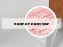 银屑病白求恩 银屑病中医叫白