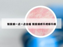 银屑病一点一点会痛 银屑病疼不疼痒不痒