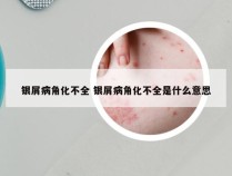 银屑病角化不全 银屑病角化不全是什么意思