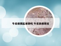 牛皮癣摸起来硬吗 牛皮肤癣硬皮