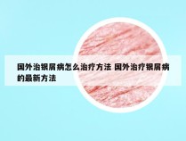 国外治银屑病怎么治疗方法 国外治疗银屑病的最新方法