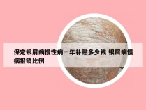 保定银屑病慢性病一年补贴多少钱 银屑病慢病报销比例