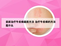 目前治疗牛皮癣最新方法 治疗牛皮癣的方法是什么