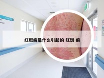 红斑癣是什么引起的 红斑 癣