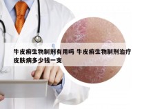 牛皮癣生物制剂有用吗 牛皮癣生物制剂治疗皮肤病多少钱一支