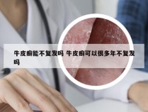 牛皮癣能不复发吗 牛皮癣可以很多年不复发吗