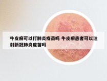牛皮癣可以打肺炎疫苗吗 牛皮癣患者可以注射新冠肺炎疫苗吗