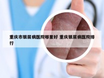 重庆市银屑病医院哪里好 重庆银屑病医院排行