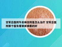 空军总医院牛皮癣住院是怎么治疗 空军总医院那个医生看银屑病看的好