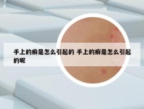 手上的癣是怎么引起的 手上的癣是怎么引起的呢