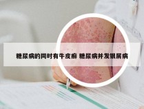 糖尿病的同时有牛皮癣 糖尿病并发银屑病