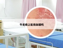 牛皮癣上能拔血罐吗