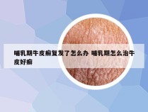 哺乳期牛皮癣复发了怎么办 哺乳期怎么治牛皮好癣