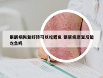 银屑病恢复好转可以吃鳕鱼 银屑病康复后能吃鱼吗