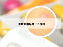 牛皮癣刚起是什么样的