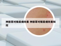 神肤草对银屑病效果 神肤草对银屑病效果如何