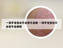 一周岁宝宝会不会有牛皮癣 一周岁宝宝会不会有牛皮癣呢