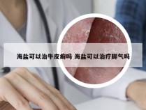 海盐可以治牛皮癣吗 海盐可以治疗脚气吗