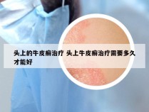 头上的牛皮癣治疗 头上牛皮癣治疗需要多久才能好