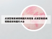 点滴型银屑病初期图片和现象 点滴型银屑病初期症状和图片大全
