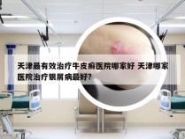 天津最有效治疗牛皮癣医院哪家好 天津哪家医院治疗银屑病最好?
