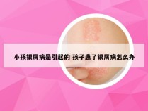 小孩银屑病是引起的 孩子患了银屑病怎么办