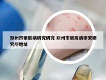 郑州市银屑病研究研究 郑州市银屑病研究研究所地址