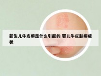 新生儿牛皮癣是什么引起的 婴儿牛皮肤癣症状