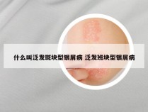 什么叫泛发斑块型银屑病 泛发班块型银屑病