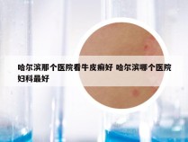 哈尔滨那个医院看牛皮癣好 哈尔滨哪个医院妇科最好
