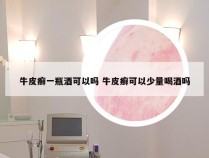 牛皮癣一瓶酒可以吗 牛皮癣可以少量喝酒吗