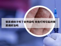 银屑病蚊子咬了会传染吗 蚊虫叮咬引起的银屑病好治吗