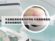 牛皮癣能用他克莫司软膏吗 牛皮肤癣用他克莫司有依赖性吗
