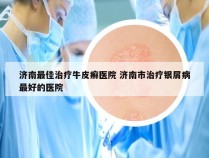 济南最佳治疗牛皮癣医院 济南市治疗银屑病最好的医院