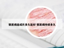 银屑病连成片多久能好 银屑病持续多久