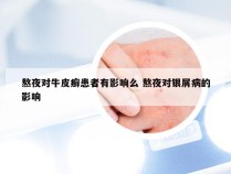 熬夜对牛皮癣患者有影响么 熬夜对银屑病的影响