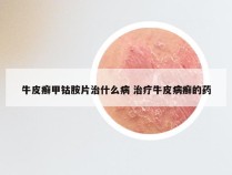 牛皮癣甲钴胺片治什么病 治疗牛皮病癣的药